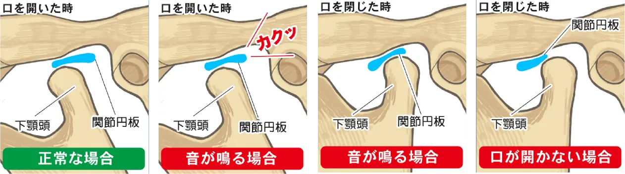 イメージ:顎関節症の代表的な症状
