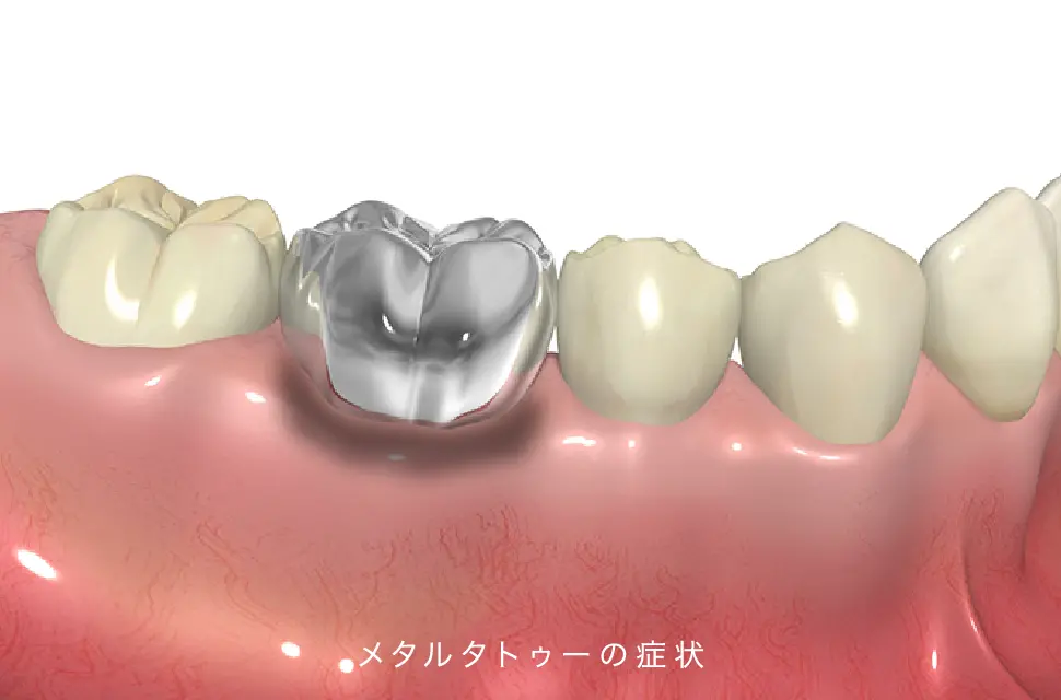 イメージ:メタルタトゥーと金属アレルギー